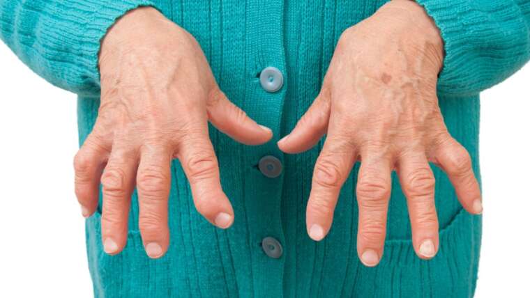 Melatonina e artrite: como a melatonina pode ajudar a aliviar a dor da artrite